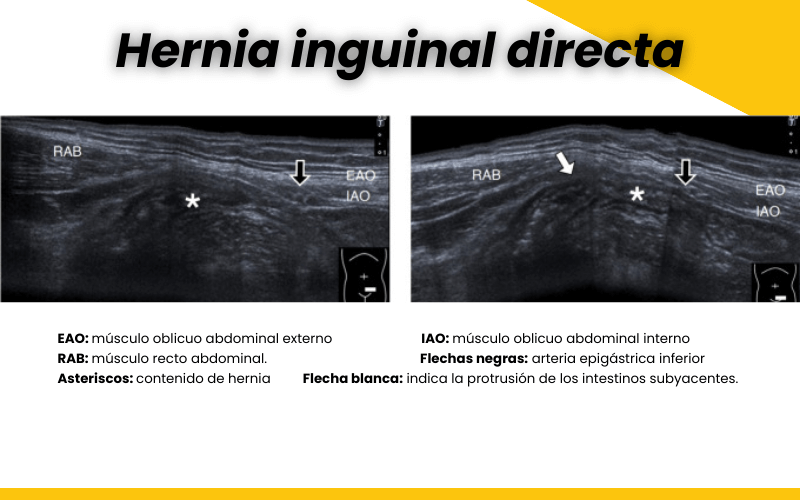 Hernia inguinal directa y ecografía | Tempo Formación